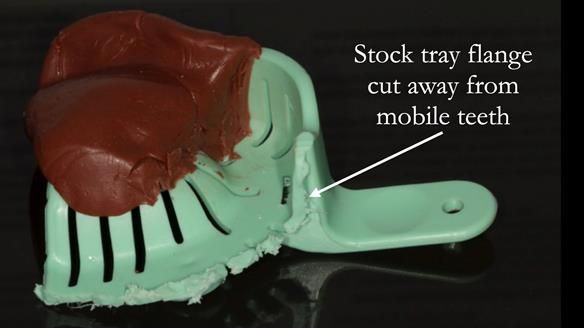 Finlay's Case Study Newsletter 40 - Immediate Mk 1 RPD to Definitive Mk 2 RPD - full protocol