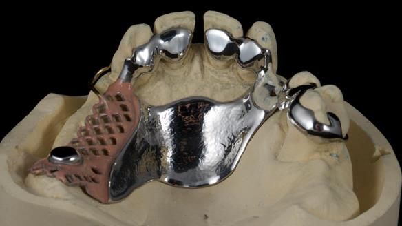 Newsletter 86 Peter the Architect — precision removable partial dentures case study