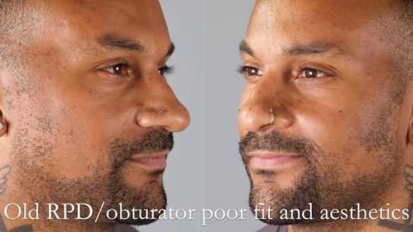 Acrylic based partial denture/obturator had poor, retention and support Obturator section was in poor condition. The Adams clasp were causing inflammation of the gingival margins. The clasp on the UR3 was visible resulting in poor appearance. Reduced lip