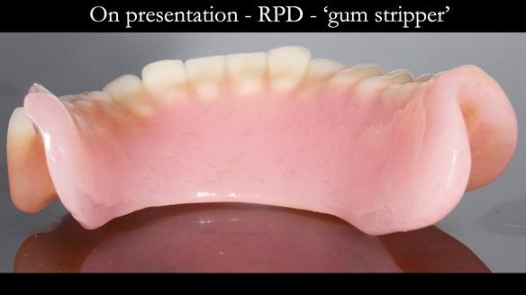 Finlay's Newsletter 59 Ultra hard partial dentures made for Gill