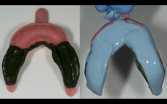 Figure 72 greenstick on saddles border moulded. Adhesive placed (blueprint) alginate mixed, glazed with wet finger and ready to take the impression
