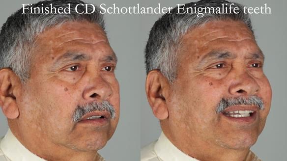 Finlay's Newsletter 62 provision of extractions and metal based complete dentures for Rafique