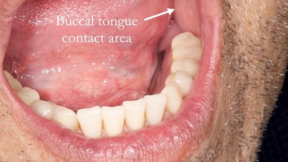 Finlay's Newsletter 62 provision of extractions and metal based complete dentures for Rafique