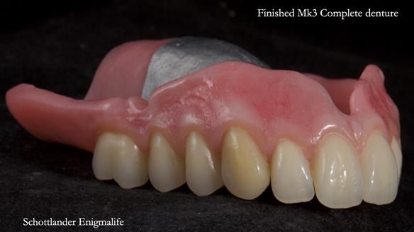 Newsletter 77: Jeremy’s case – immediate complete upper denture