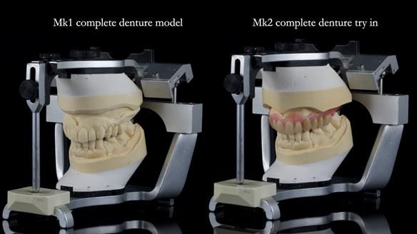 Newsletter 77: Jeremy’s case – immediate complete upper denture