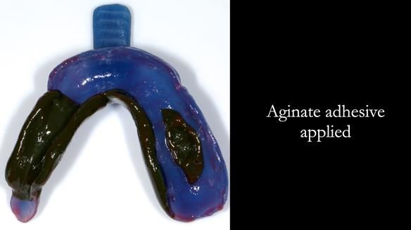 Finlay's Newsletter 61 provision of a lower unilateral free end saddle metal based partial denture for Joyce