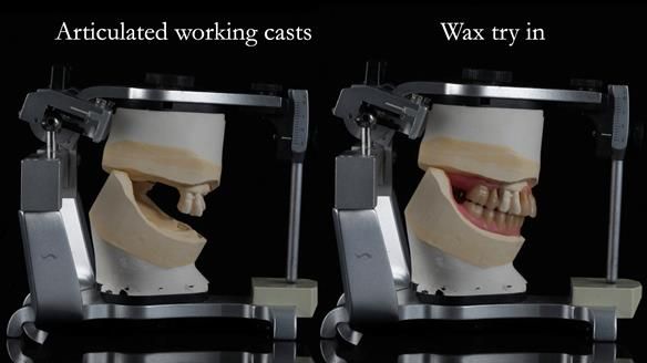 Finlay's Newsletter 59 Ultra hard partial dentures made for Gill