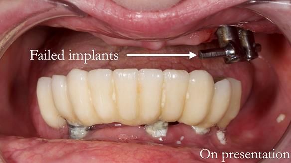 Newsletter 49 Managing Estelle’s failing implants with dentures FULL PROTOCOL
