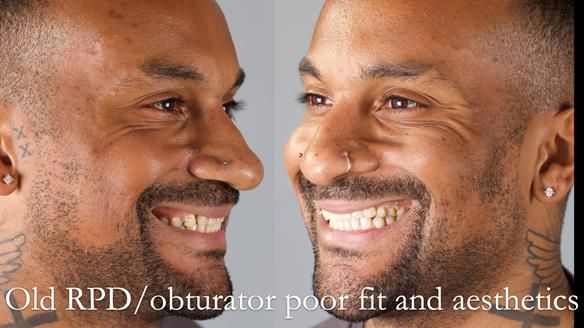 Acrylic based partial denture/obturator had poor, retention and support Obturator section was in poor condition. The Adams clasp were causing inflammation of the gingival margins. The clasp on the UR3 was visible resulting in poor appearance. Reduced lip