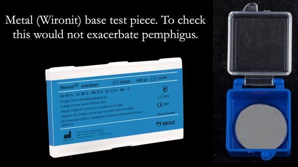 Newsletter 56 showing the making and fitting of a bilateral free end saddle upper removable partial denture (RPD) for patient with pemphigus