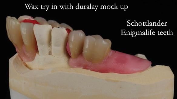 Finlay's Newsletter 59 Ultra hard partial dentures made for Gill