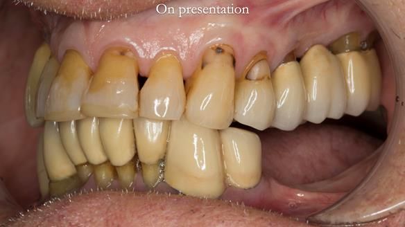 Ken – going downhill, first class