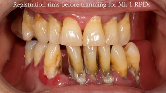 Finlay's Case Study Newsletter 40 - Immediate Mk 1 RPD to Definitive Mk 2 RPD - full protocol