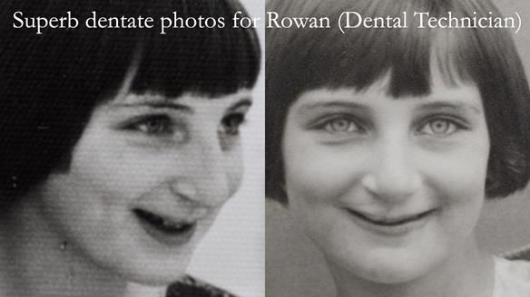 Newsletter 55 Provision of metal based partial dentures for Zephyrine with a repaired cleft lip and palate