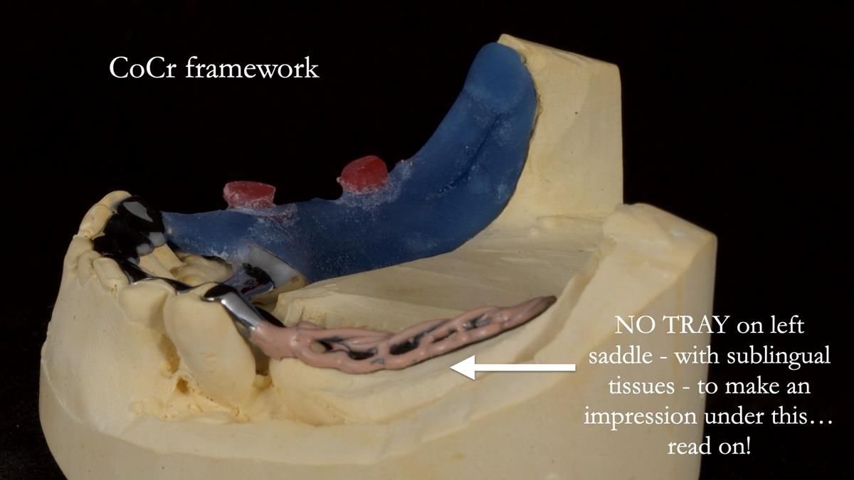 Newsletter 87 – Father Peter: A Partial Denture that needed Minor Miracle