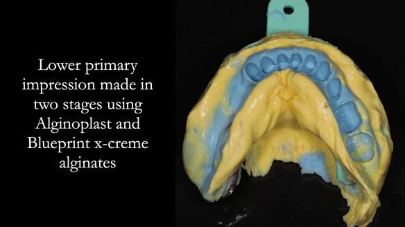 Finlay's Newsletter 61 provision of a lower unilateral free end saddle metal based partial denture for Joyce