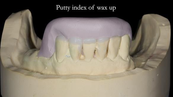 Newsletter 52 Managing Jo’s failing dentition with extractions and Mk 1/Mk 2 complete upper dentures and lower partial dentures FULL PROTOCOL