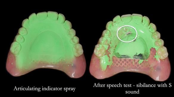 Newsletter 82 Mary - A complete upper and a one-tooth gasket denture