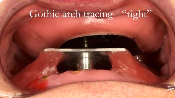 Sequence of use - patient is instructed to move lower jaw the left