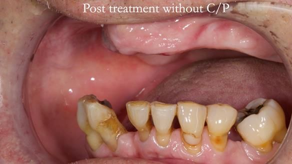 Newsletter 54 case presentation upper complete denture and lower Scandinavian designed hygienic partial denture for David