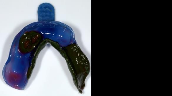 Newsletter 86 Peter the Architect — precision removable partial dentures case study