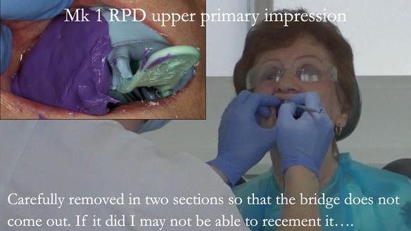 Newsletter 51 Managing Anne’s failing dentition with distal extension base RPD/Splint FULL PROTOCOL