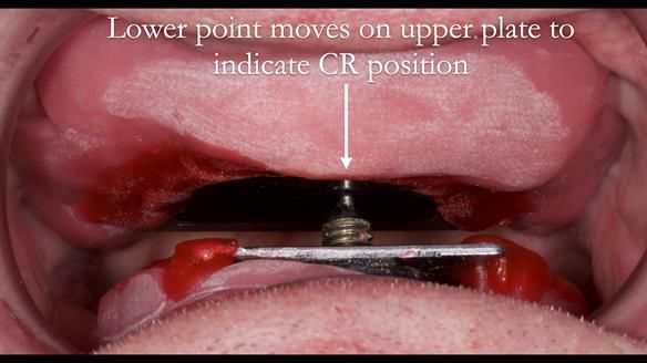 Complete denture Class II div 2 deep overbite Newsletter 39