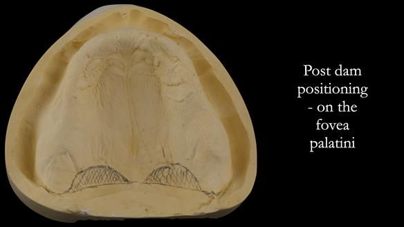 Post dam is drawn from tuberosity to tuberosity over the fovea palatini - this is then scored into the cast