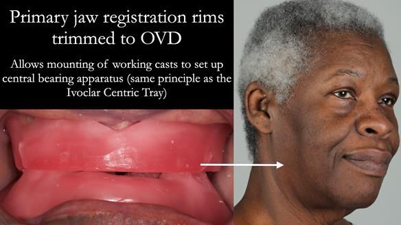 Newsletter 53 showing the making and fitting of ultra life-like dentures for Valena
