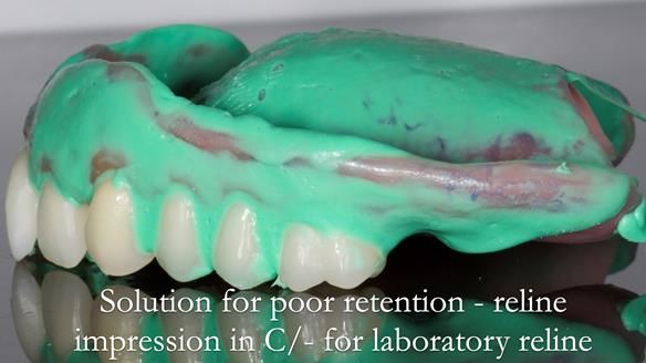 Newsletter 53 showing the making and fitting of ultra life-like dentures for Valena