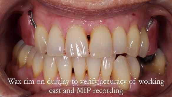 Newsletter 56 showing the making and fitting of a bilateral free end saddle upper removable partial denture (RPD) for patient with pemphigus