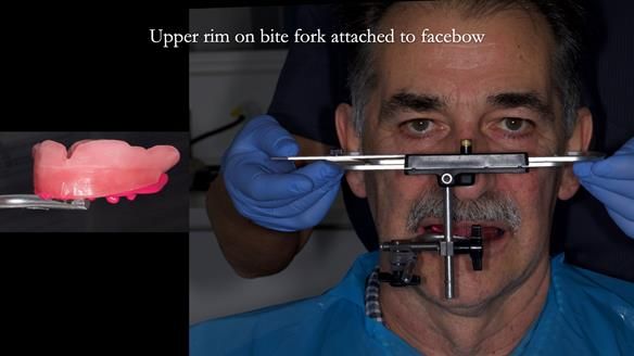 Newsletter 78: What do Clark Gable and a Locator® overdenture have in common?