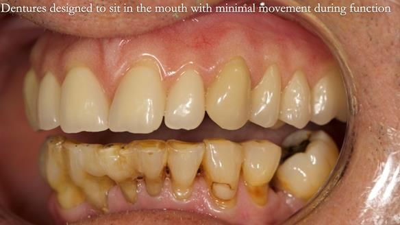 Newsletter 54 case presentation upper complete denture and lower Scandinavian designed hygienic partial denture for David