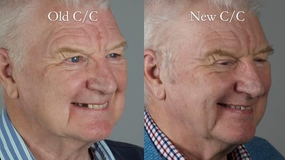 Newsletter 57 showcases the making and fitting process of implant-supported complete dentures for Alisdair