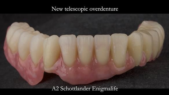 Newsletter 76: Jackie’s case – Telescopic overdenture & precision RPD (the tricky truth!)
