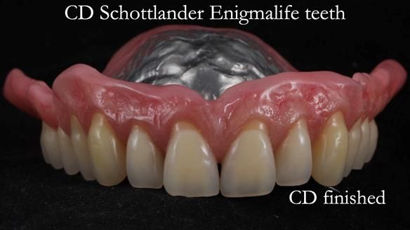 Finlay's Newsletter 62 provision of extractions and metal based complete dentures for Rafique