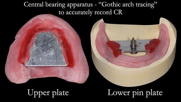 Complete denture Class II div 2 deep overbite Newsletter 39