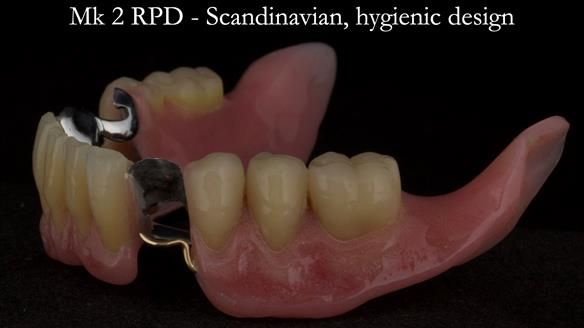 Finlay's Case Study Newsletter 40 - Immediate Mk 1 RPD to Definitive Mk 2 RPD - full protocol