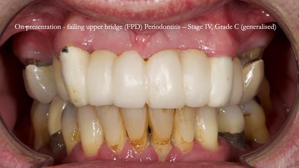 Newsletter 77: Jeremy’s case – immediate complete upper denture