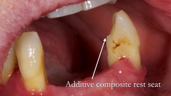 Finlay's Case Study Newsletter 40 - Immediate Mk 1 RPD to Definitive Mk 2 RPD - full protocol
