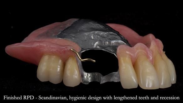 Finlay's Newsletter 59 Ultra hard partial dentures made for Gill