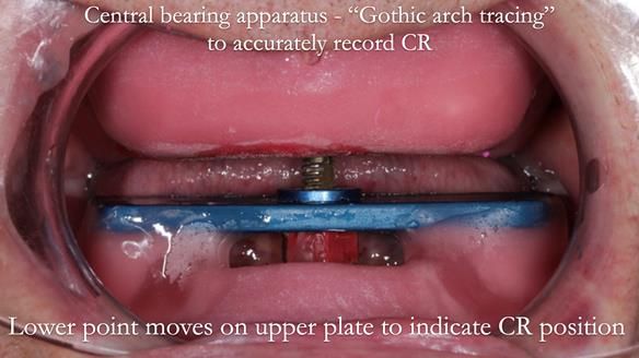 Newsletter 50 Special edition Complete Dentures FULL PROTOCOL