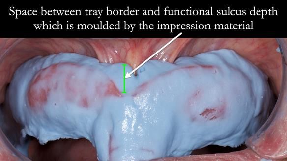 Finlay's Newsletter 62 provision of extractions and metal based complete dentures for Rafique