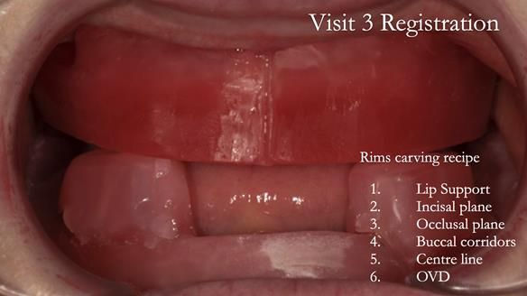 Newsletter 75: Marion’s case - Step-by-step complete denture workflow