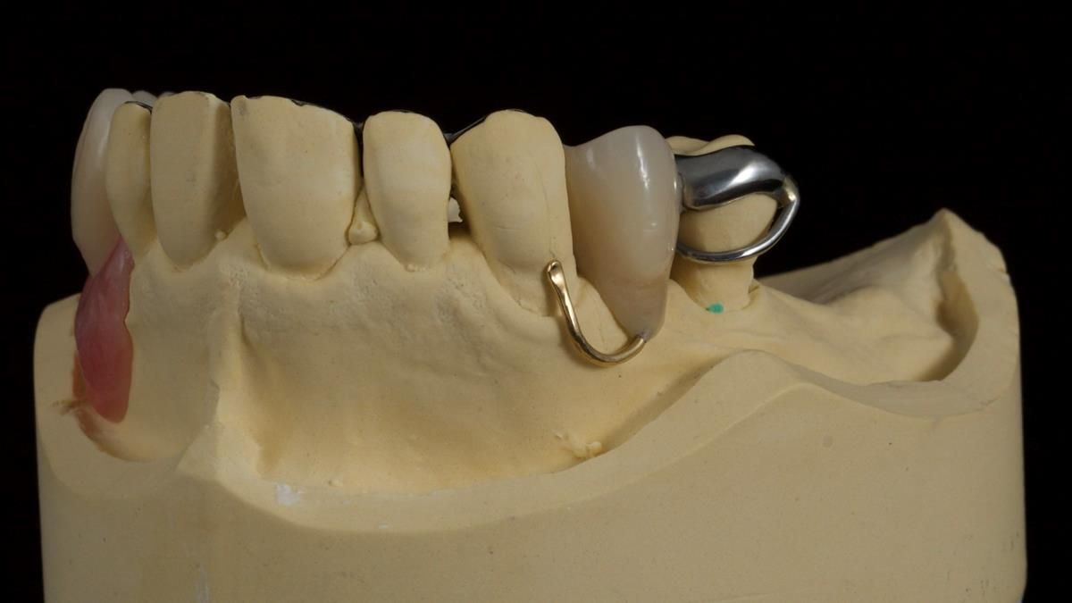 Newsletter 89 – Simon: A Challenging Kennedy Class II Division 1 Upper CoCr Partial Denture with a High Smile Line