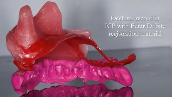 Upper metal base partial denture/occlusal stabilisation splint/obturator - full protocol
