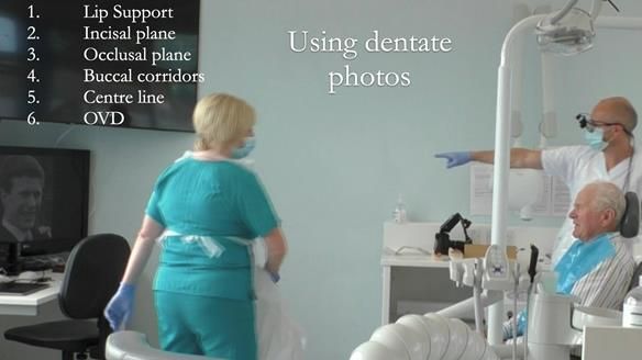 Complete denture Class II div 2 deep overbite Newsletter 39