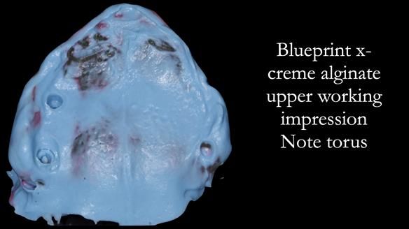 Solving Linda’s Failed “All on 4” implant bridges - full protocol Newsletter 42