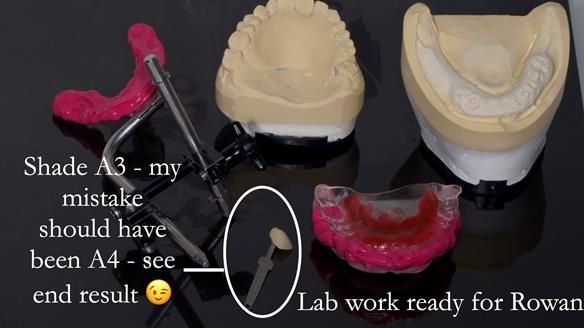 Newsletter 44 - extreme removable prosthodontics – engineering a super-strong and ultra-thin over denture