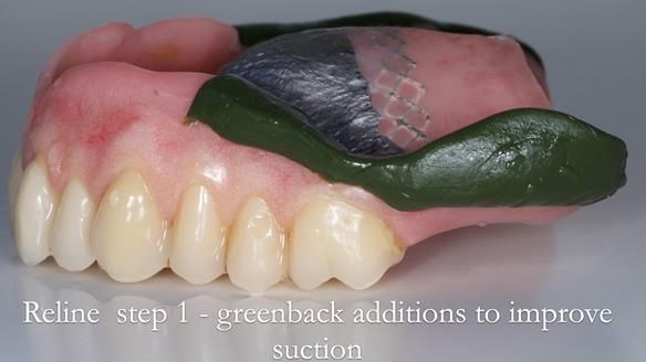 Newsletter 54 case presentation upper complete denture and lower Scandinavian designed hygienic partial denture for David